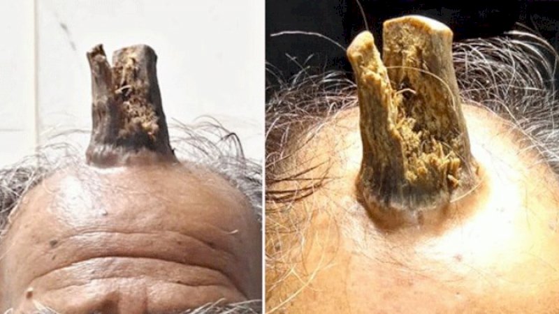 Terbentur Keras 5 Tahun Lalu, di Kepala Pria Ini Tumbuh Tanduk