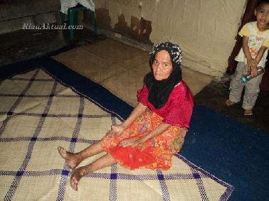 Masyarakat Terkena Kusta, Pemerintah Tutup Mata