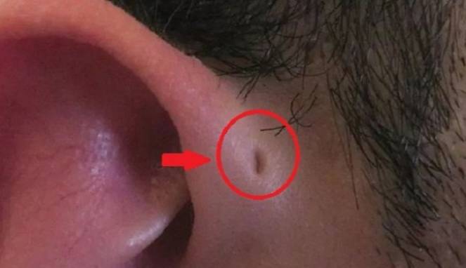 Punya Lubang Kecil di Atas Telinga? Ini Penjelasannya
