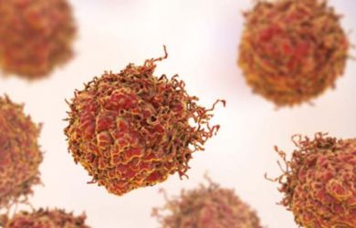 Penyakit Kanker Jenis Ini Lebih Senang Bersarang di Tubuh Wanita