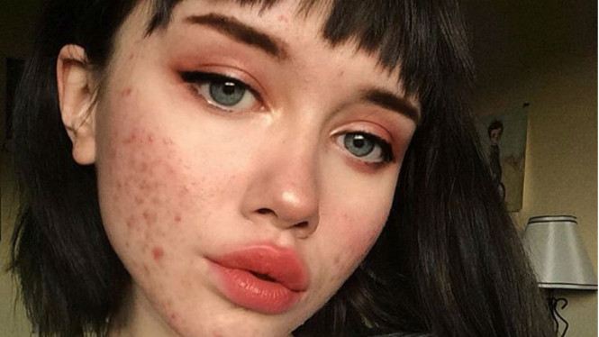 Begini Cara Menggunakan Pepaya untuk Hilangkan Bekas Jerawat