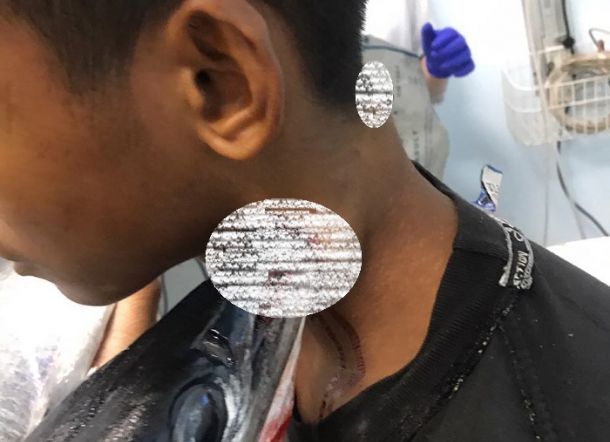 Tertusuk Ikan Sori di Leher, Siswa SMP Buton 14 Jam Menunggu Dioperasi