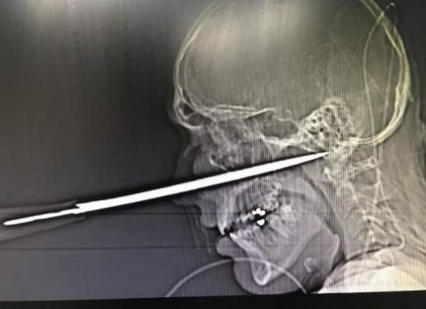 Nyaris Tewas Usai Pisau Tertancap di Wajahnya, Kurang 1mm dari Kematian