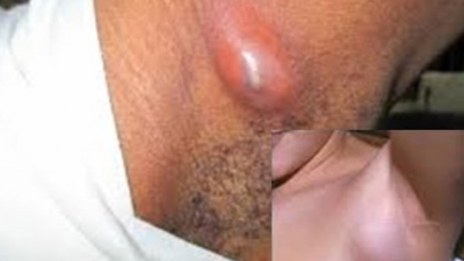 Ada Benjolan di Ketiak? Waspadai, Ini Dia Penyebabnya