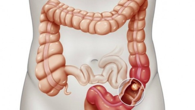 4 Gejala Kanker Usus Besar yang Sering Diabaikan