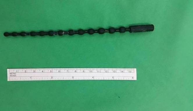 Kelewat Asyik, Mainan Seks 20 Cm Nyangkut di Saluran Kencing