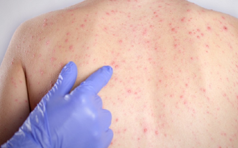 Ini Cara Menyembuhkan Gabagen Pada Anak Anak dan Bayi