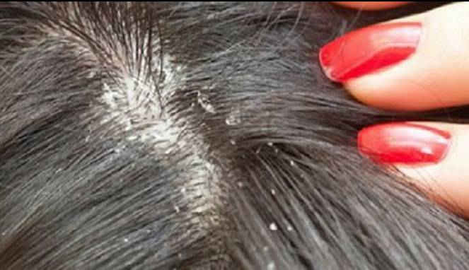 Empat Mitos Kutu Rambut yang Sering Dianggap Fakta