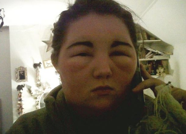 Karena Pewarna Rambut, Wajah Wanita Ini Membesar