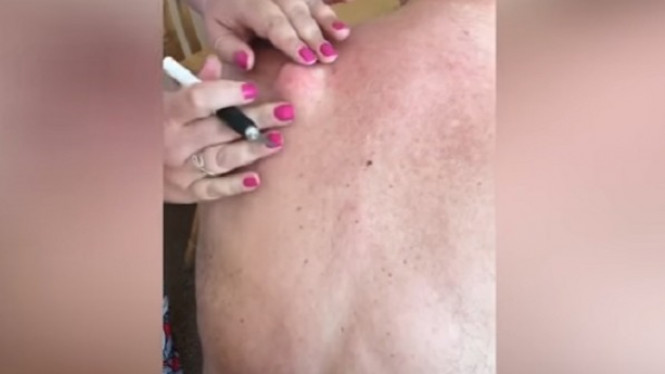 Benjolan Berumur 25 Tahun di Punggung Dipecahkan, Isinya Bikin...