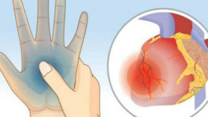 Sebulan Sebelum Serangan Jantung, Enam Gejala Ini Muncul