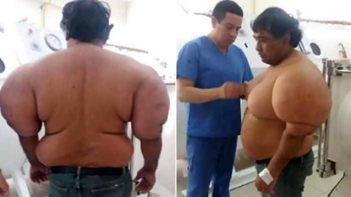 Terlalu Cepat Naik Saat Menyelam, Tubuh Pria ini Membengkak, Ternyata ini yang Terjadi