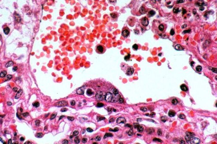 Virus Mematikan Tanpa Obat Mewabah di India, Berpotensi Ancam Dunia