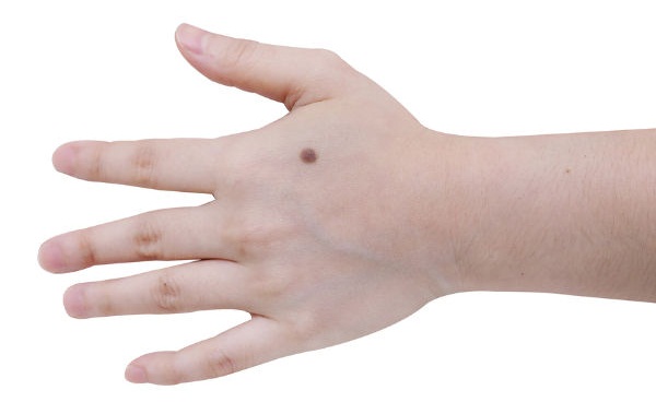 Konon, Tahi Lalat di Daerah Ini Menandakan Nasib Buruk