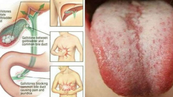 Alami 8 Gejala Ini, Segera Lakukan Detoksifikasi