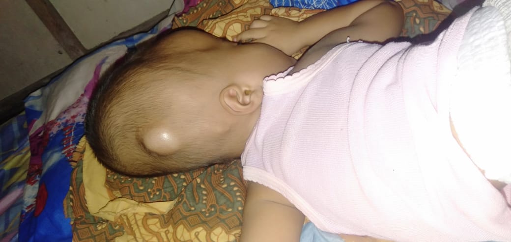 Menderita Hidrosefalus,  Bocah 2 Tahun Butuh Uluran Tangan Donatur