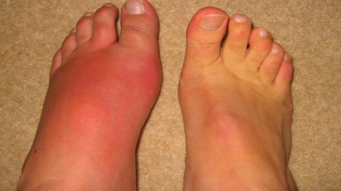 4 Makanan Ini Picu Naiknya Kadar Asam Urat