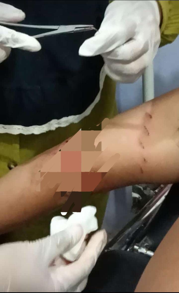 Lengan Robek Bekas Gigitan, Warga Sikakak Kuansing Diduga Diterkam Buaya Saat Mandi Malam di Batang Kuantan