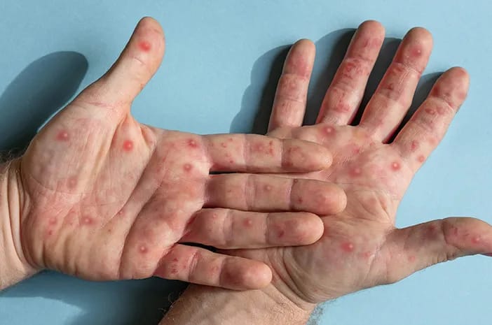 2 Santri di Riau Diduga Terjangkit Cacar Monyet, Kemenkes Angkat Bicara