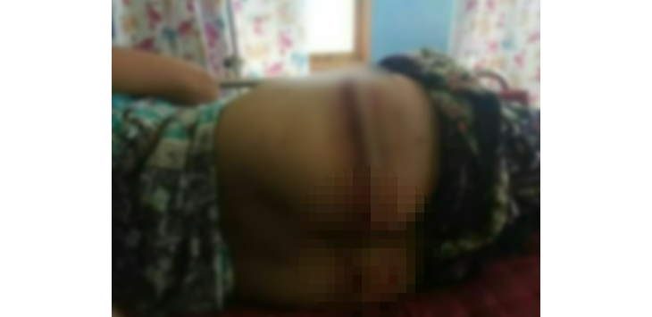 Lagi Asyik Buang Air Besar, Tiba-tiba Bokong Ibu Ini Digigit Buaya