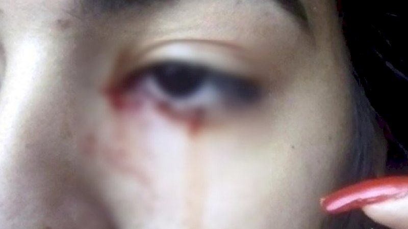 Gadis Remaja Keluarkan Darah dari Mata, Penyebabnya Masih Misteri