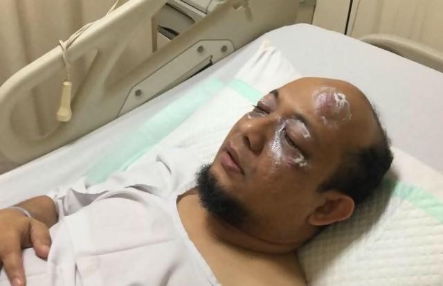 Waah ! Kornea mata Novel belum pulih dan terancam buta