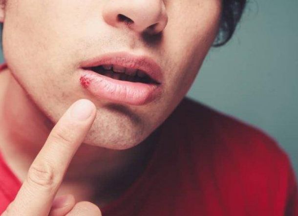 Gugat Teman Kencannya Rp2,4 Miliar karena Divonis Kena Herpes Usai Ciuman