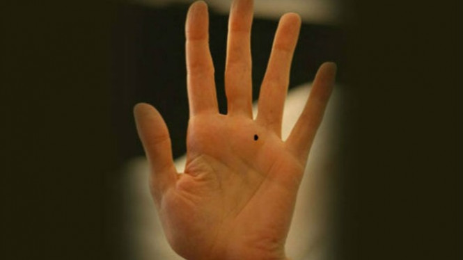 Tahi Lalat pada Bagian Tubuh Ini Menandakan Krisis Keuangan