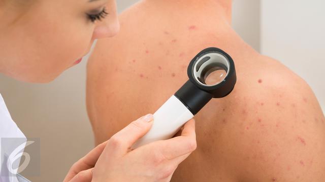 Cara Mudah Hilangkan Jerawat di Punggung