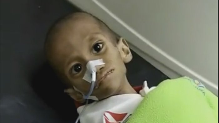 Ditinggal Orangtunya Sejak Usia 3 Bulan, Kondisi Rizal Makin Memprihatinkan