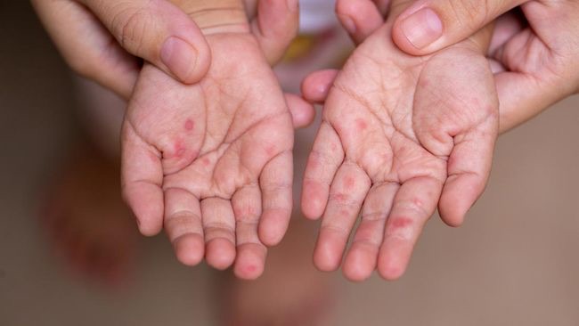 Campak Anak: Akut dan Sangat Menular! Jangan Abaikan Imunisasi