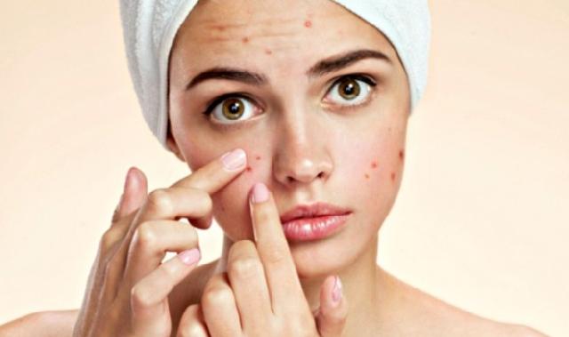 Ini Penyebab munculnya jerawat saat masa pubertas sudah lewat