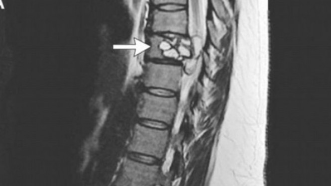 Kerap Merasakan Sensasi Tersetrum, Tanda Cacing Pita Menyerang
