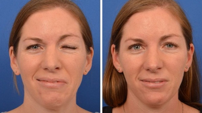 Deretan Gejala-gejala Bell's Palsy yang Perlu Anda Ketahui