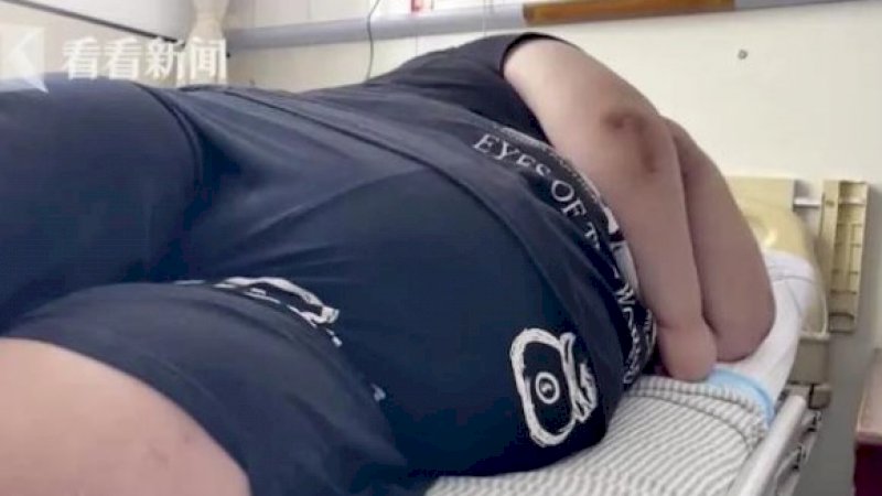 Ngeri, Habiskan Rp11 Juta Sebulan untuk Beli Makanan, Pria Berbobot 190 Kg Kini Tidur dengan Ventilator