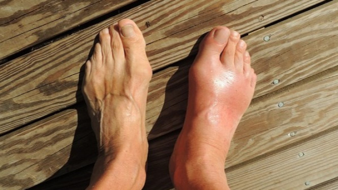 Ini 12 Obat Asam Urat Selain Tanaman dan Pil, Tanpa Efek Samping