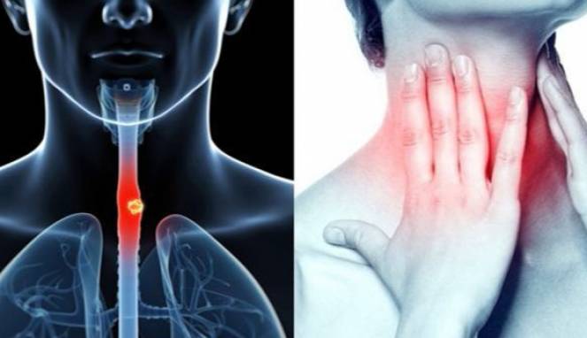 5 Gejala Awal Kanker Kerongkongan