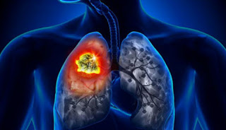 Cara Mudah Hilangkan Tar dari Paru-paru