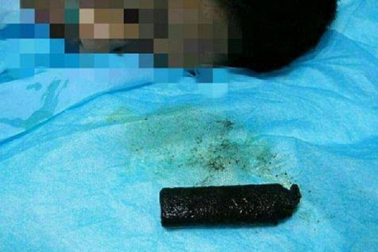 Ngeri, Dokter Keluarkan Korek Api yang 20 Tahun Berada di Perut Pria Ini