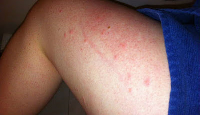 6 Gejala Awal HIV yang Sering Diabaikan