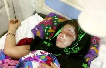 Kejam, Suami Siram Wajah Istri Dengan Cairan Asam Karena Tak Melahirkan Bayi Perempuan