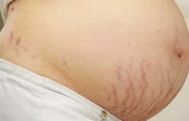 Ternyata Stretch Bisa Dihilangkan