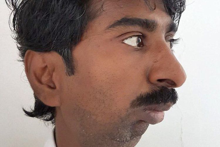 Pria Ini Akhinya Bisa Membuka Mulutnya Setelah 38 Tahun