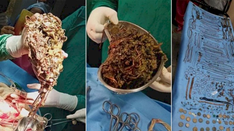 Dokter Kaget Temukan 69 Rantai, 80 Anting, dan 11 Cincin Saat Membelah Perut Wanita Ini