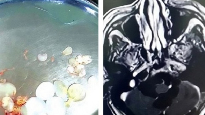 3 Kasus Mimpi Buruk Penggemar Sushi, Cacing Penuhi Tubuh