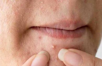 Hobi Banget Pencet Jerawat? Nih Efek Buruk Mengerikan yang Akan Kamu Terima