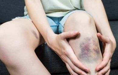 Apa Benar Memar Tiba-Tiba Pada Tubuh Itu karena Dijilat Setan?