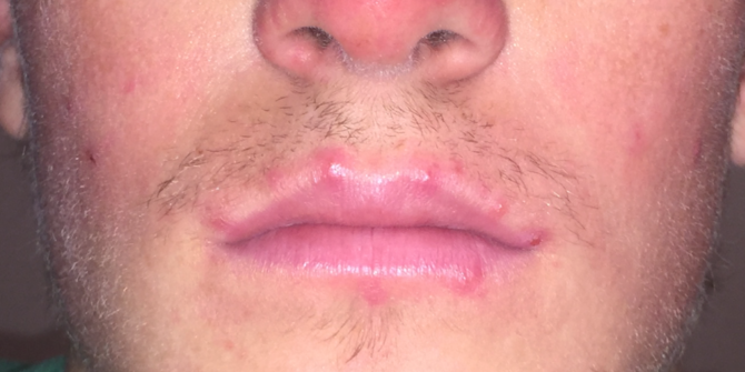 Obati dan Hindari Jerawat di Bibir dengan Berbagai Cara Berikut