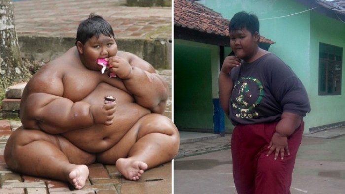 Viral Karena Obesitas, Siapa Sangka Begini Perubahan Drastis Arya Permana, Sampai Disorot Mata Dunia