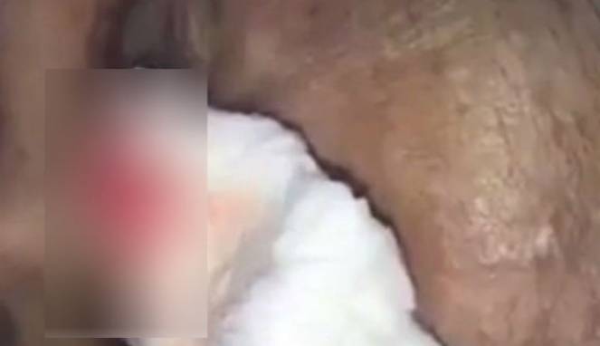 Ternyata, Proses Pengeluaran Susuk Bisa Sangat Menyakitkan